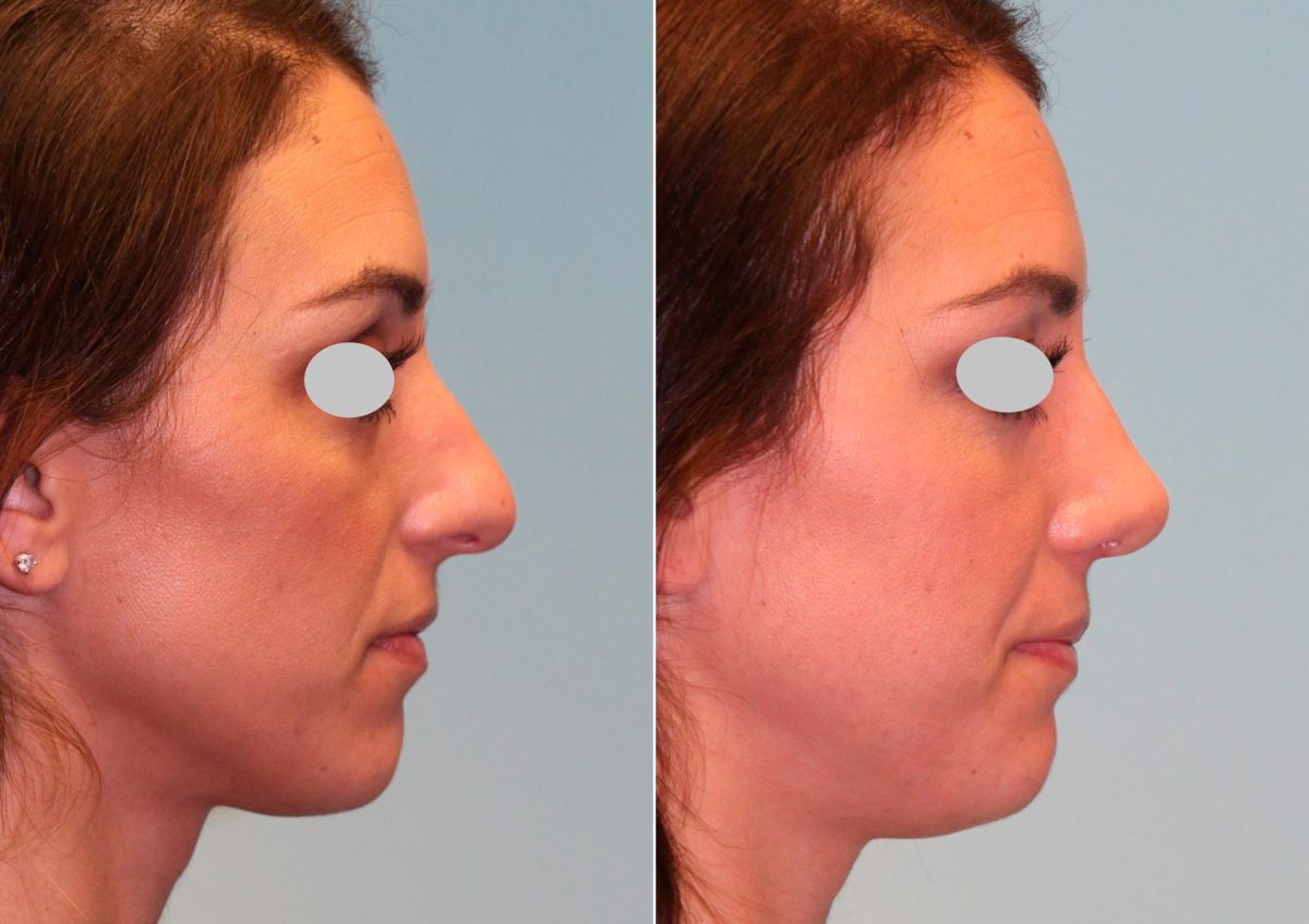 Before and after Rhinoplasty by Dr. Shervin Naderi, Patient 14928