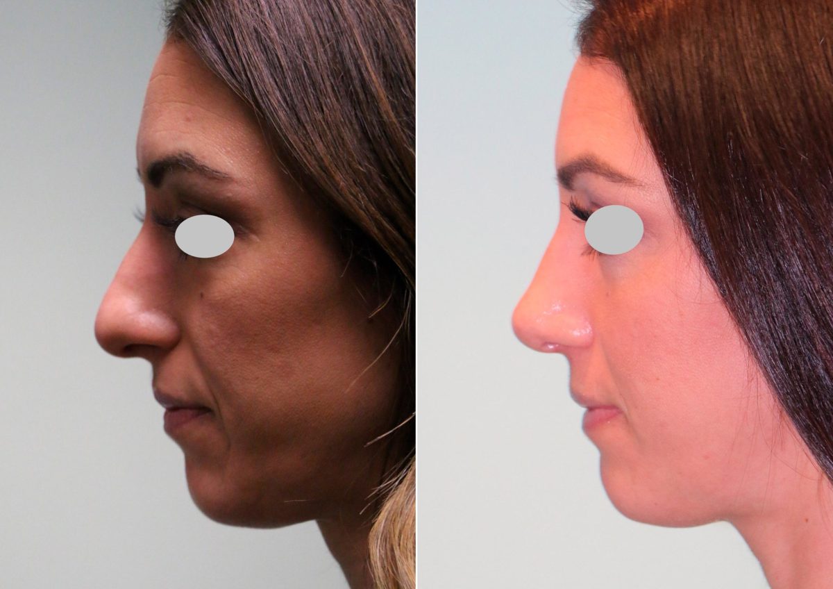 Before and after Rhinoplasty by Dr. Shervin Naderi, Patient 14928