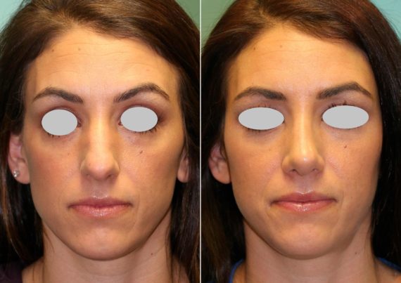 Before and after Rhinoplasty by Dr. Shervin Naderi, Patient 14928