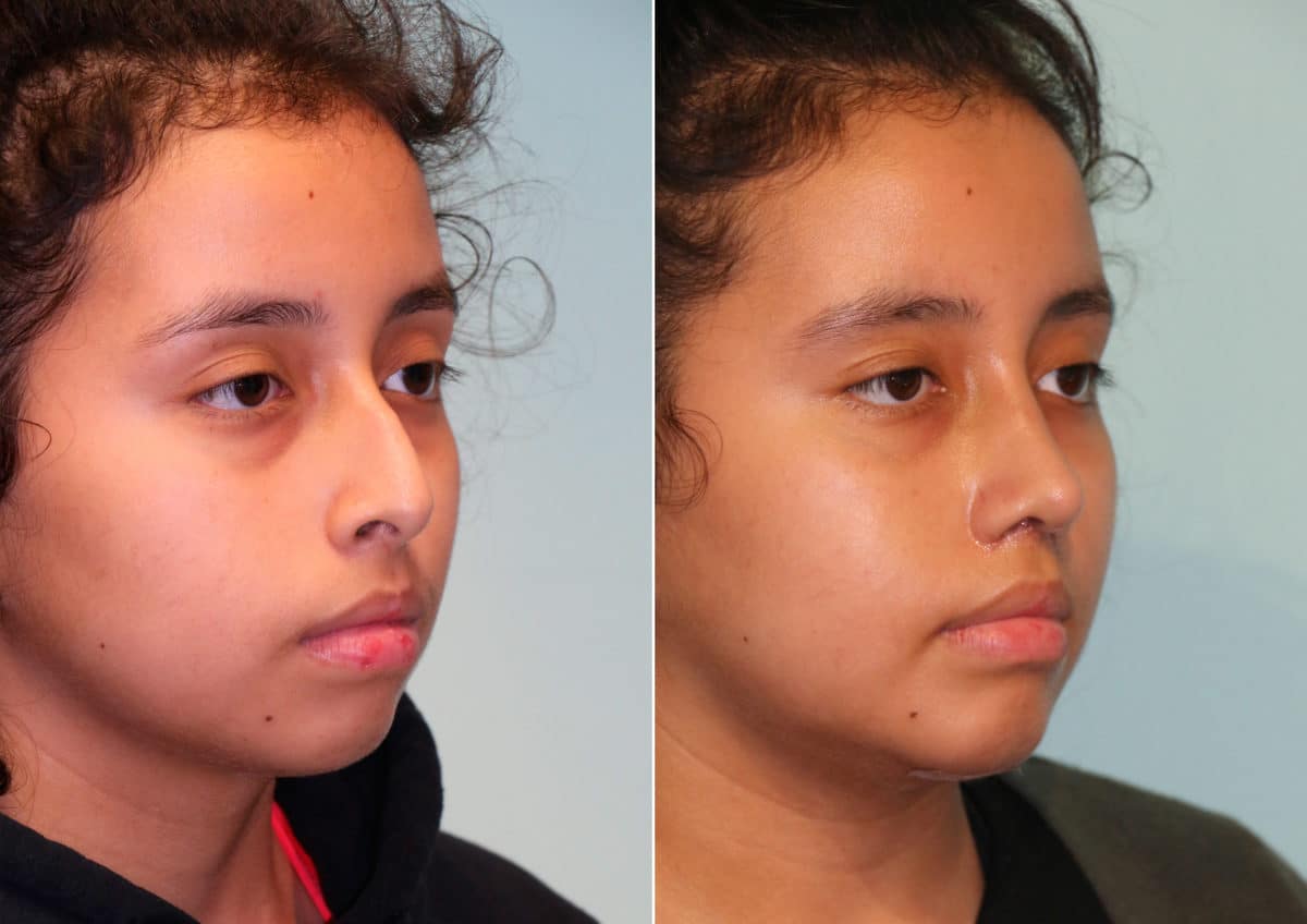 Before and after Rhinoplasty by Dr. Shervin Naderi, Patient 15016