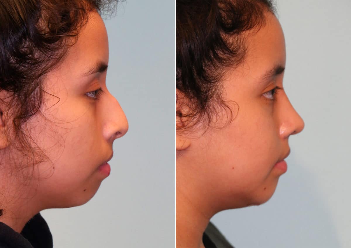 Before and after Rhinoplasty by Dr. Shervin Naderi, Patient 15016