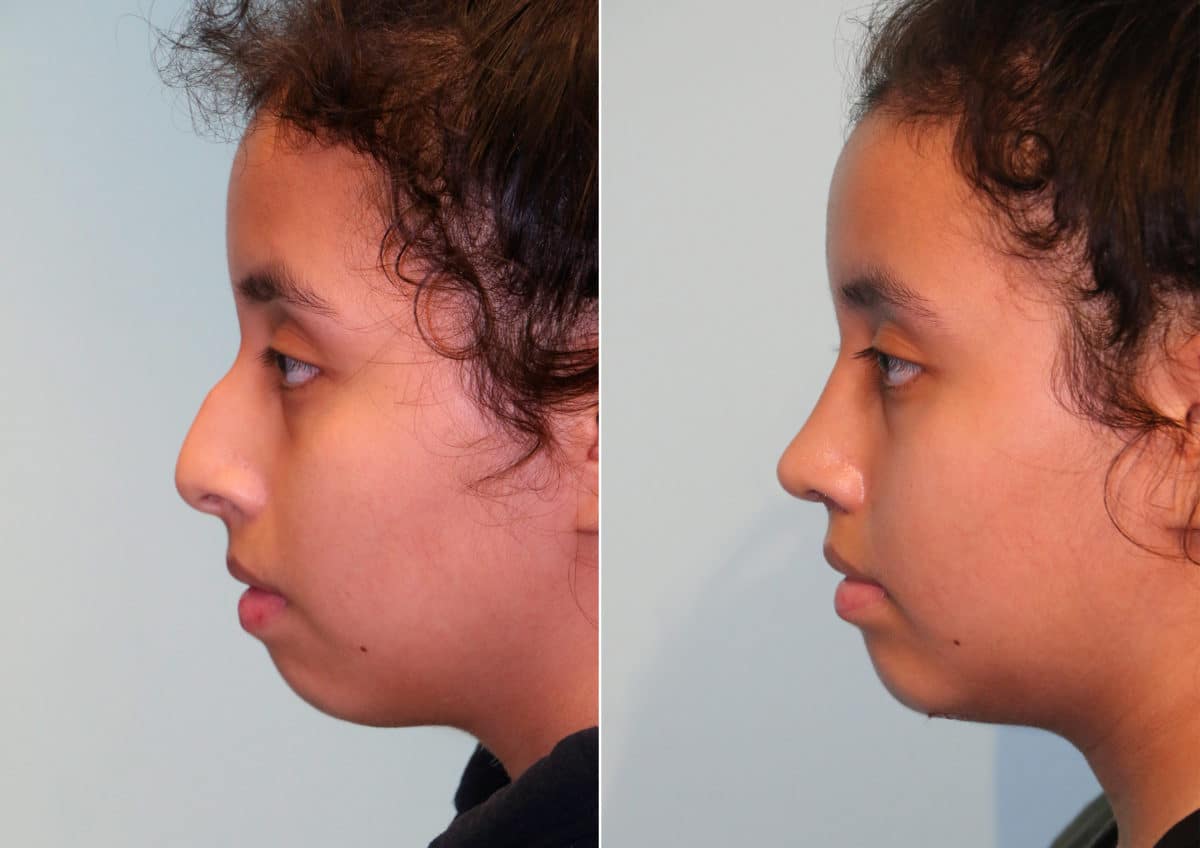 Before and after Rhinoplasty by Dr. Shervin Naderi, Patient 15016