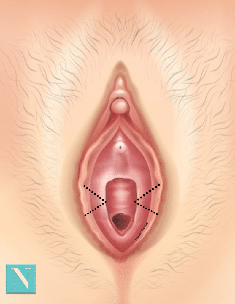 The wedge technique receives its’ name from the v-shape “wedge” incisions made on both sides of the labia.