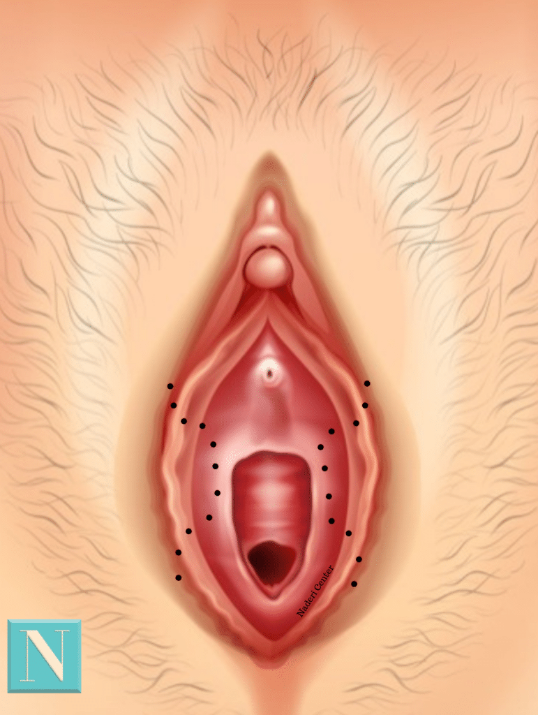 Z-plasty is a surgical technique that is used for many different types of procedures within the plastic surgery field.