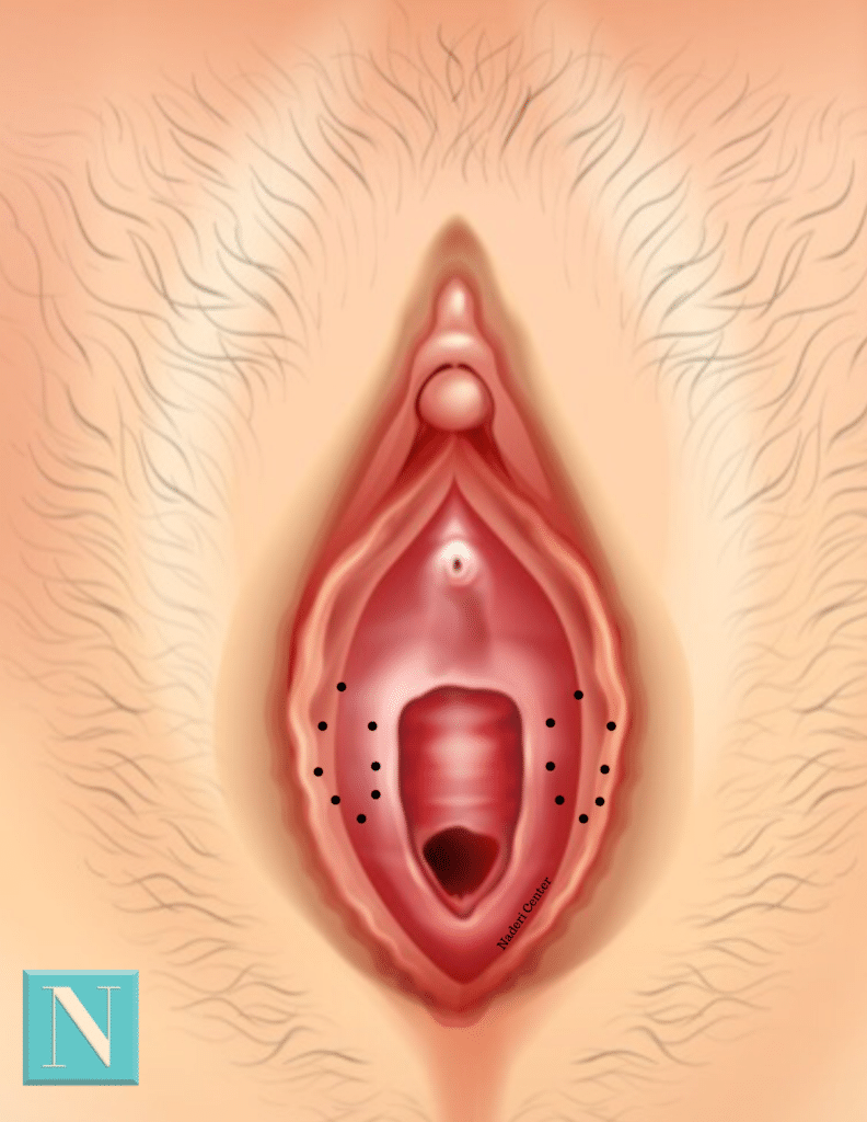 The de-epithelialization technique involves oval shaped incisions made in the inner, most central part of each minora.