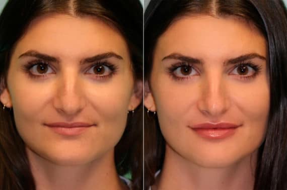 Before and after Lip Augmentation by Dr. Shervin Naderi, Patient 15113