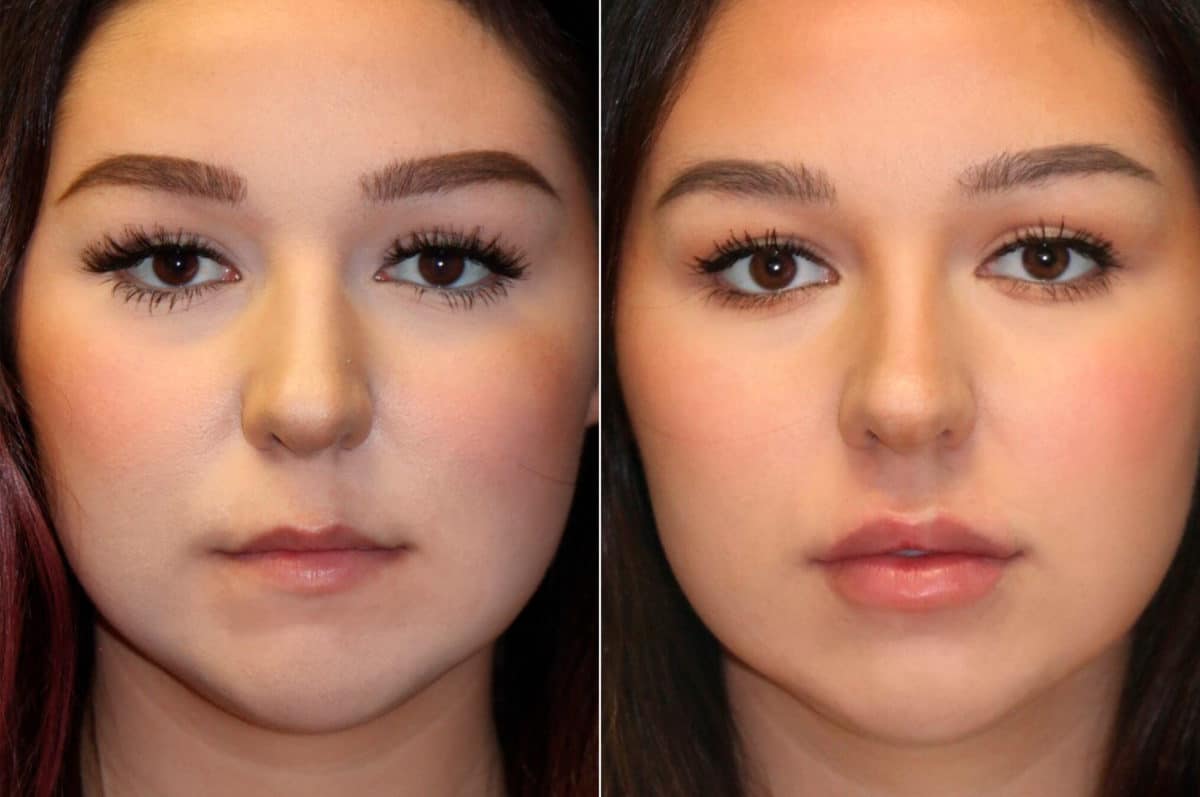 Before and after Lip Augmentation by Dr. Shervin Naderi, Patient 15105