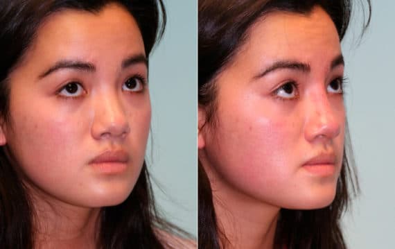 Before and after Non-Surgical Rhinoplasty by Dr. Shervin Naderi, Patient 15288