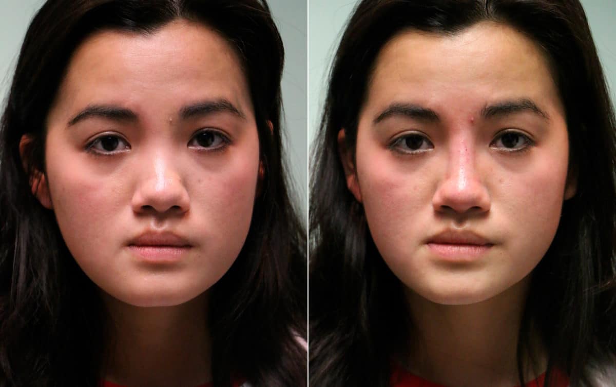 Before and after Non-Surgical Rhinoplasty by Dr. Shervin Naderi, Patient 15288