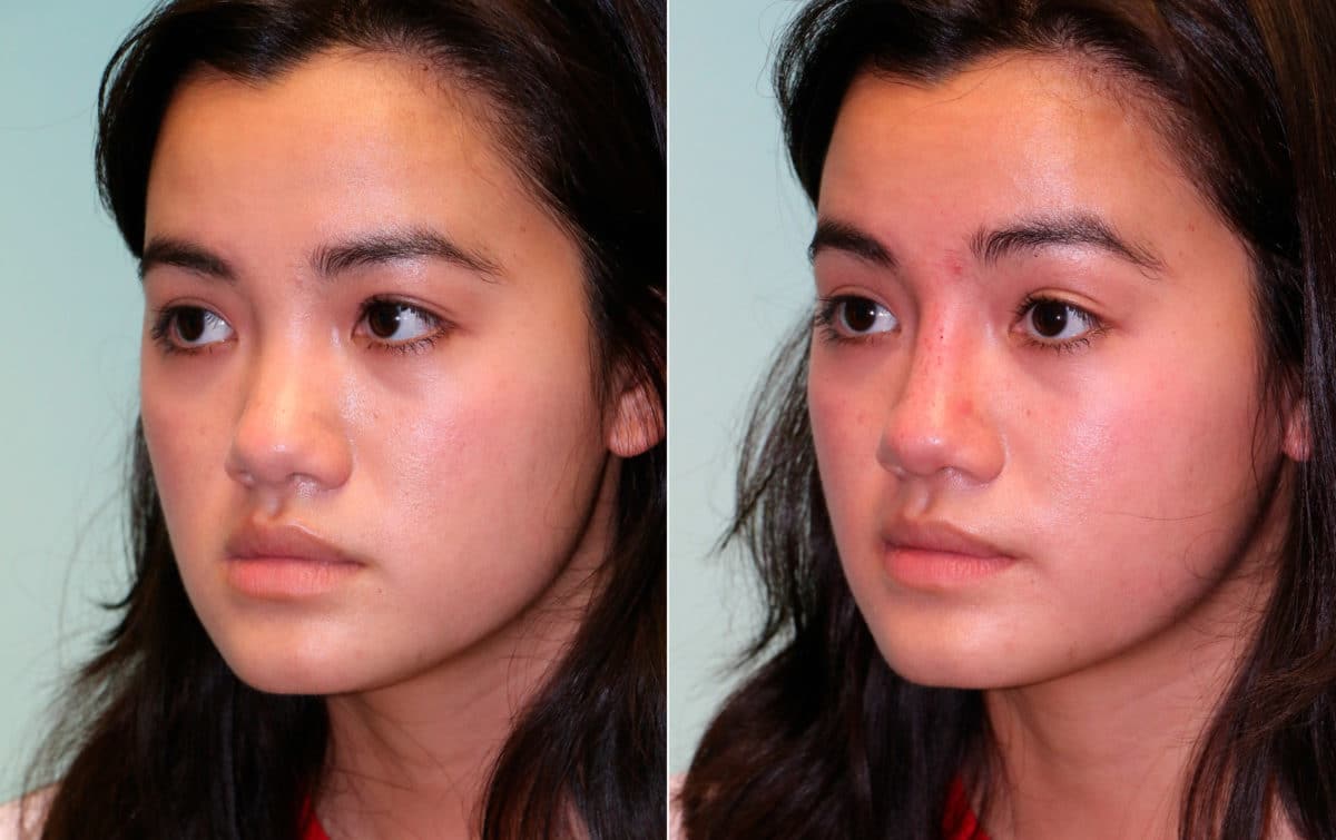 Before and after Non-Surgical Rhinoplasty by Dr. Shervin Naderi, Patient 15288