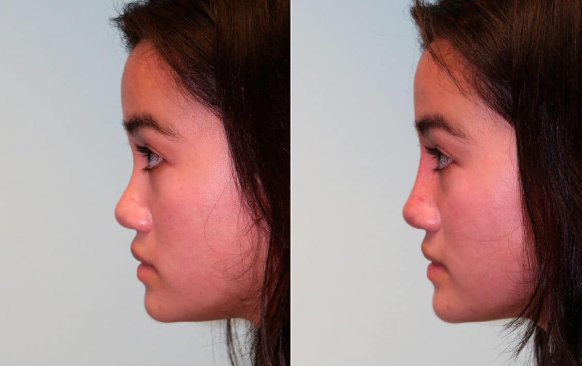 Before and after Non-Surgical Rhinoplasty by Dr. Shervin Naderi, Patient 15288