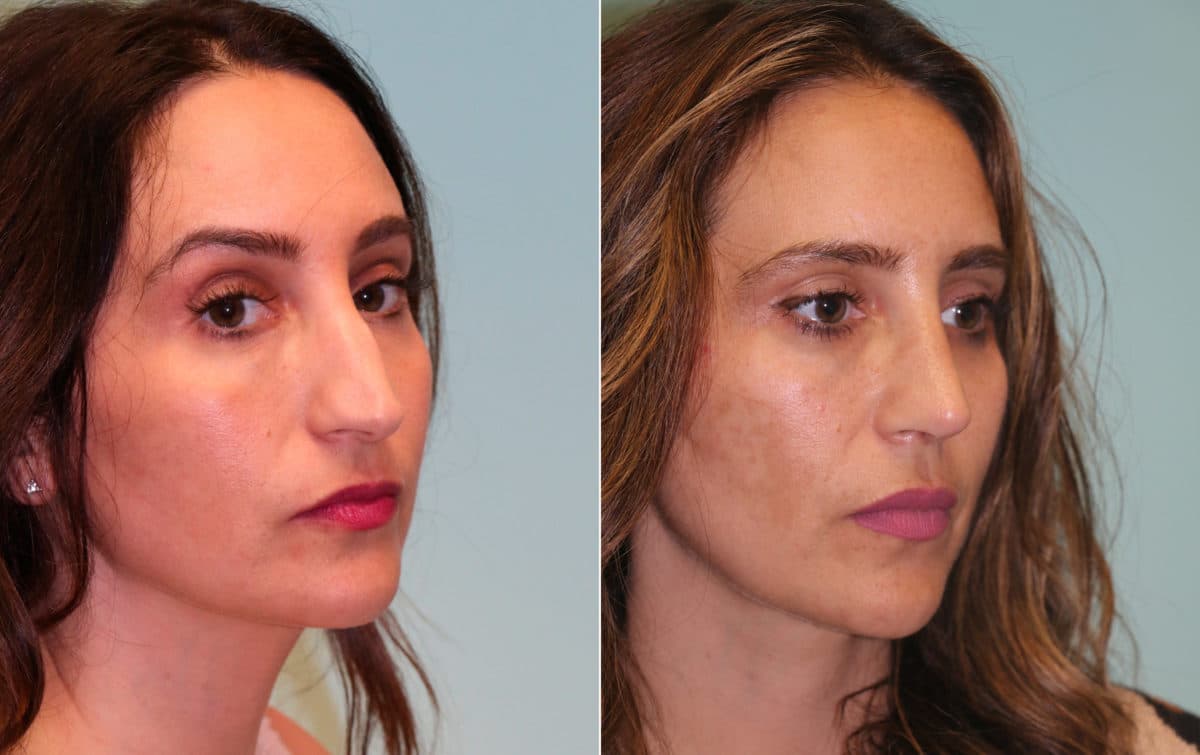 Before and after Rhinoplasty by Dr. Shervin Naderi, Patient 15272