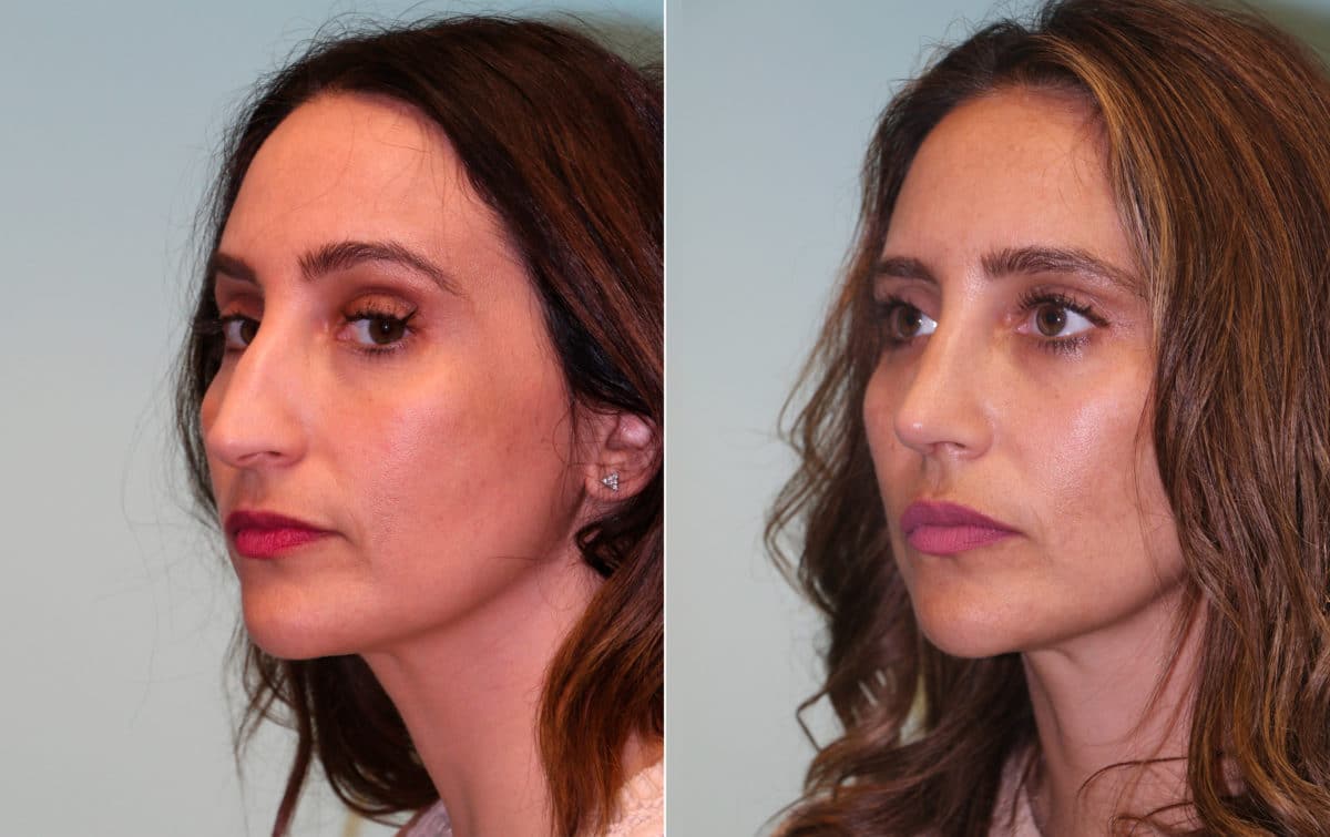 Before and after Rhinoplasty by Dr. Shervin Naderi, Patient 15272