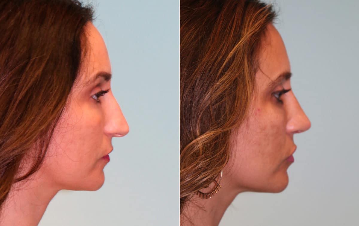 Before and after Rhinoplasty by Dr. Shervin Naderi, Patient 15272