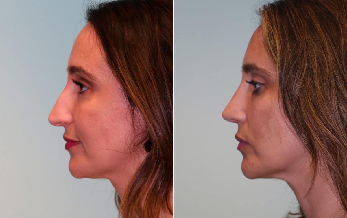 Before and after Rhinoplasty by Dr. Shervin Naderi, Patient 15272