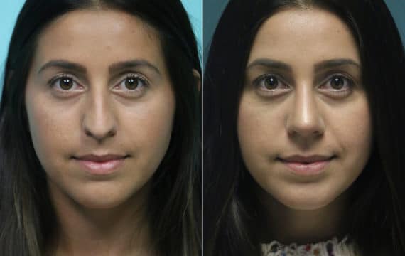 Before and after Rhinoplasty by Dr. Shervin Naderi, Patient 15301