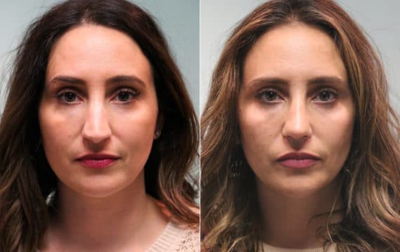 Before and after Rhinoplasty by Dr. Shervin Naderi, Patient 15272