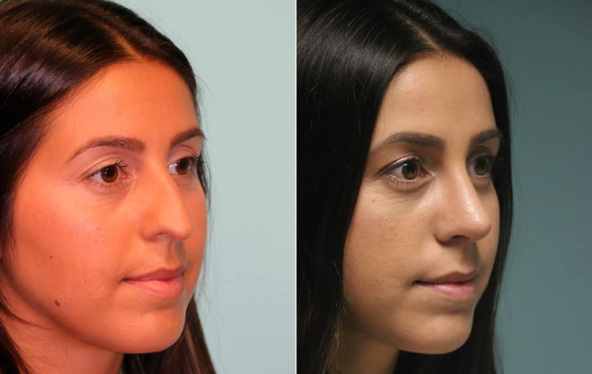 Before and after Rhinoplasty by Dr. Shervin Naderi, Patient 15301