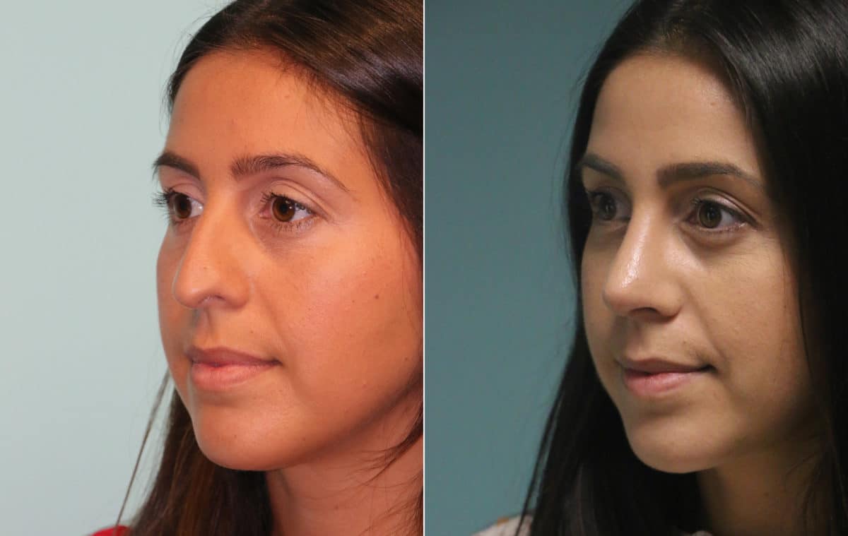 Before and after Rhinoplasty by Dr. Shervin Naderi, Patient 15301