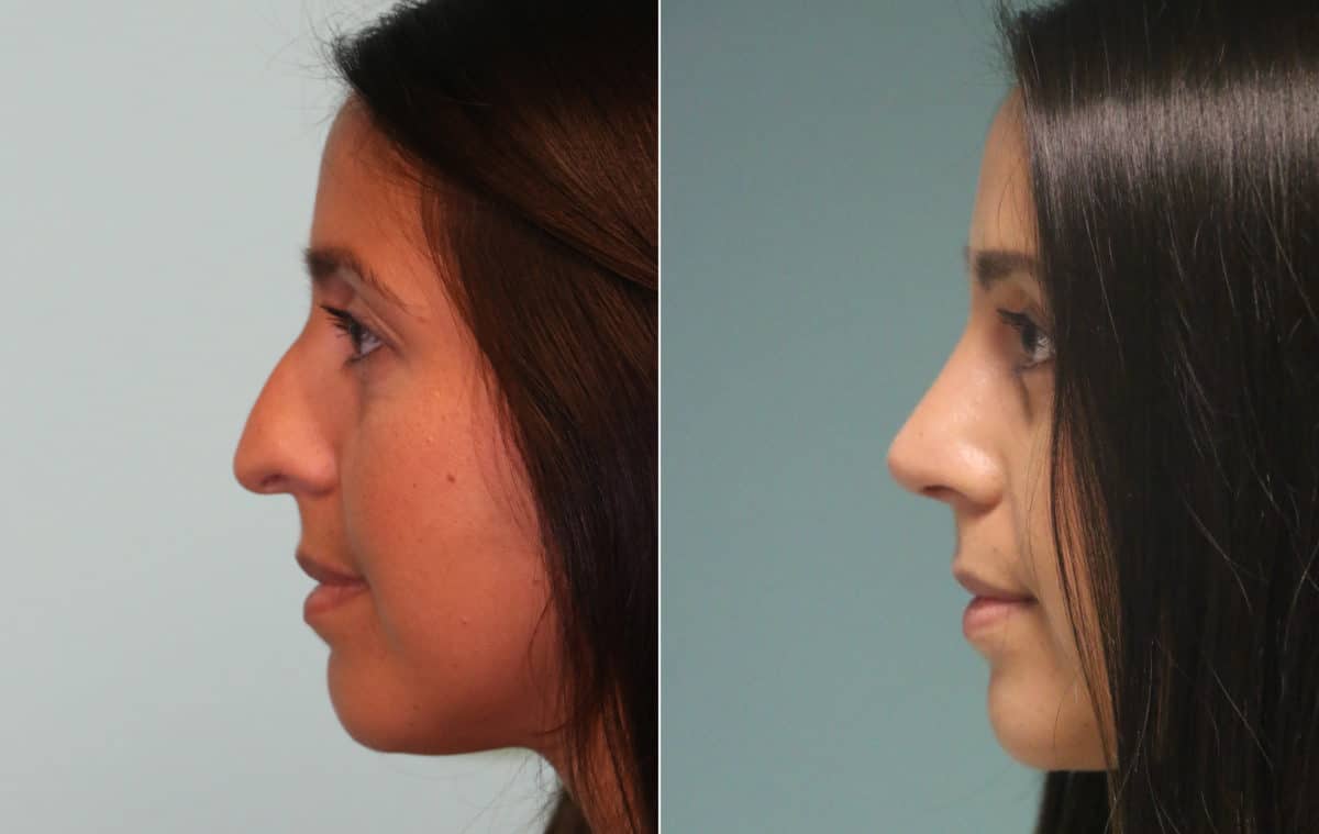 Before and after Rhinoplasty by Dr. Shervin Naderi, Patient 15301