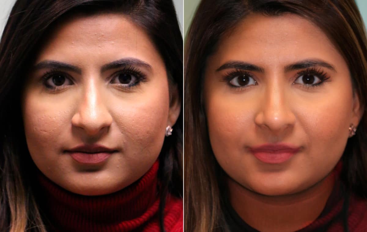 Before and after Rhinoplasty by Dr. Shervin Naderi, Patient 15354