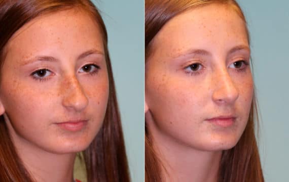 Before and after Revision Rhinoplasty by Dr. Shervin Naderi, Patient 15344