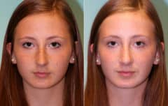 Before and after Revision Rhinoplasty by Dr. Shervin Naderi, Patient 15344