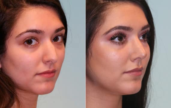 Before and after Rhinoplasty by Dr. Shervin Naderi, Patient 15325