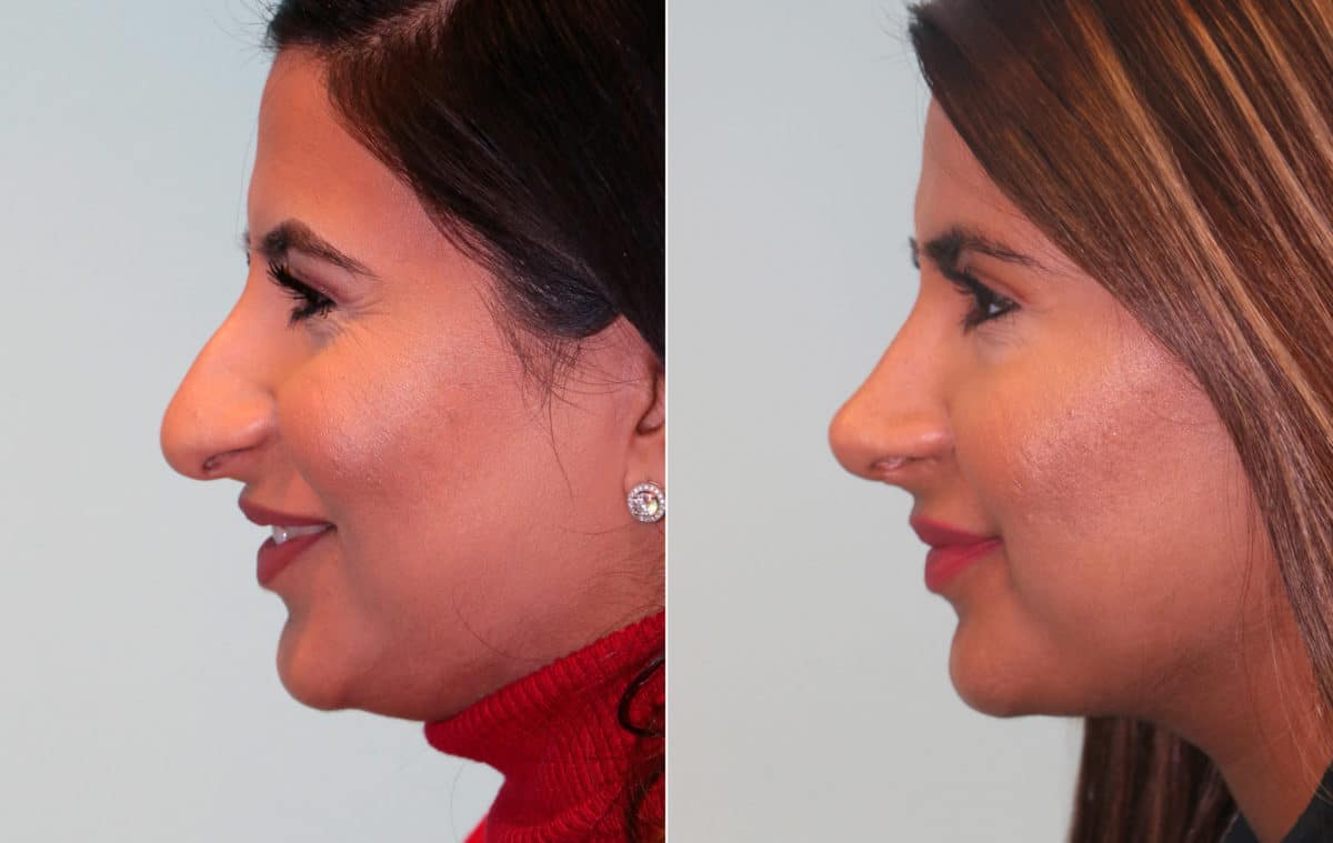 Before and after Rhinoplasty by Dr. Shervin Naderi, Patient 15354