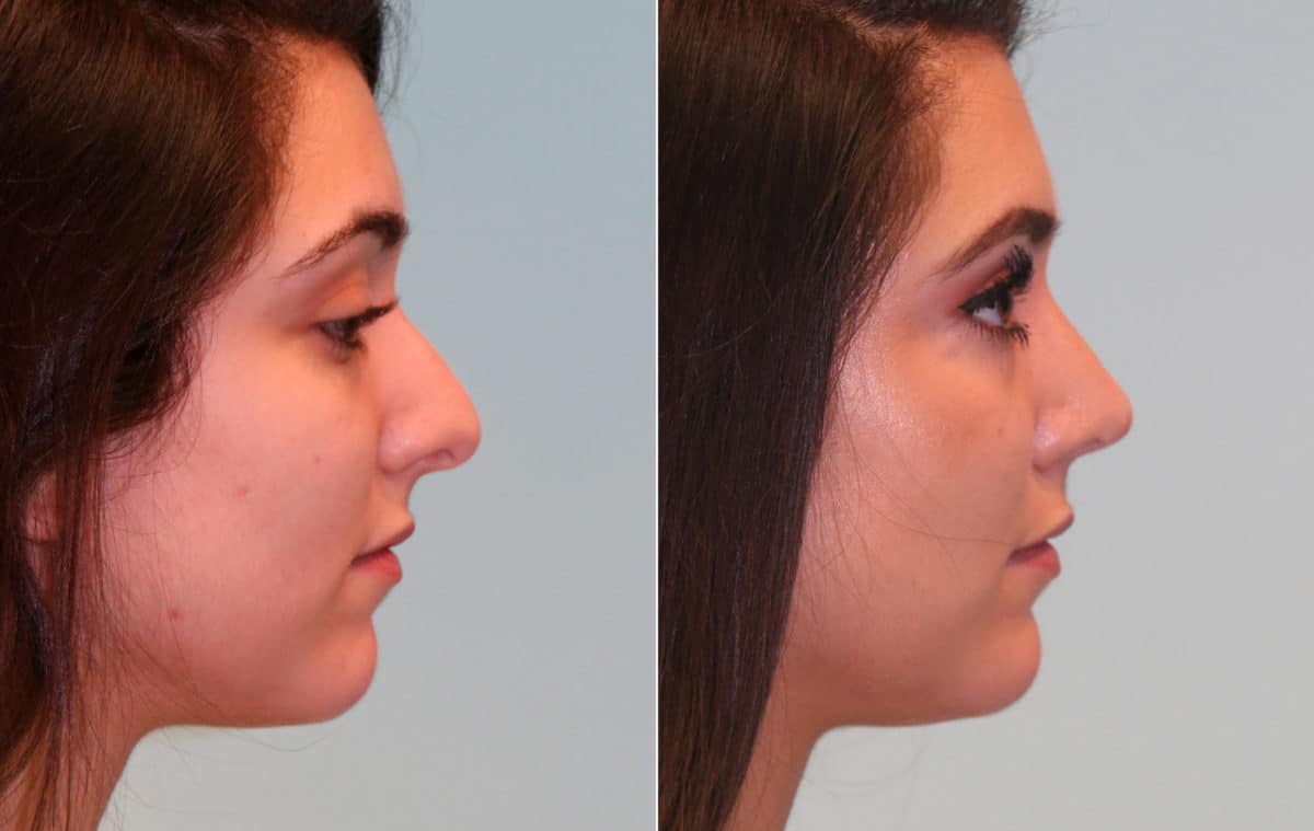 Before and after Rhinoplasty by Dr. Shervin Naderi, Patient 15325