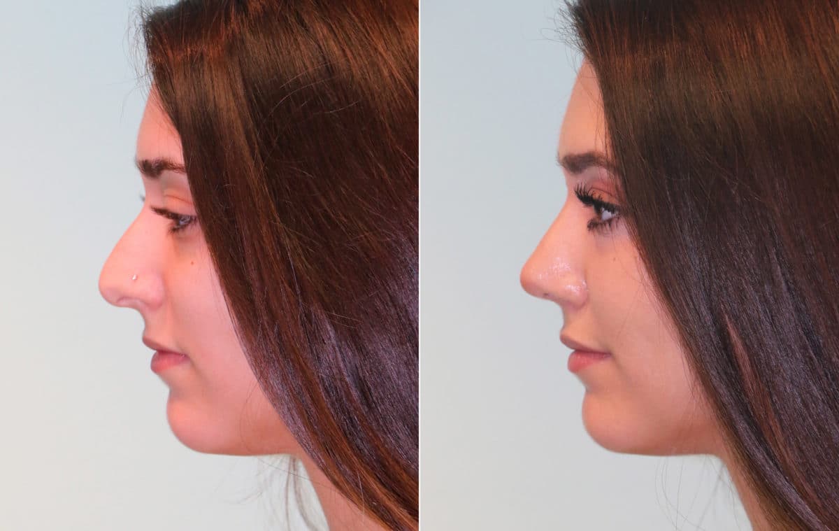 Before and after Rhinoplasty by Dr. Shervin Naderi, Patient 15325