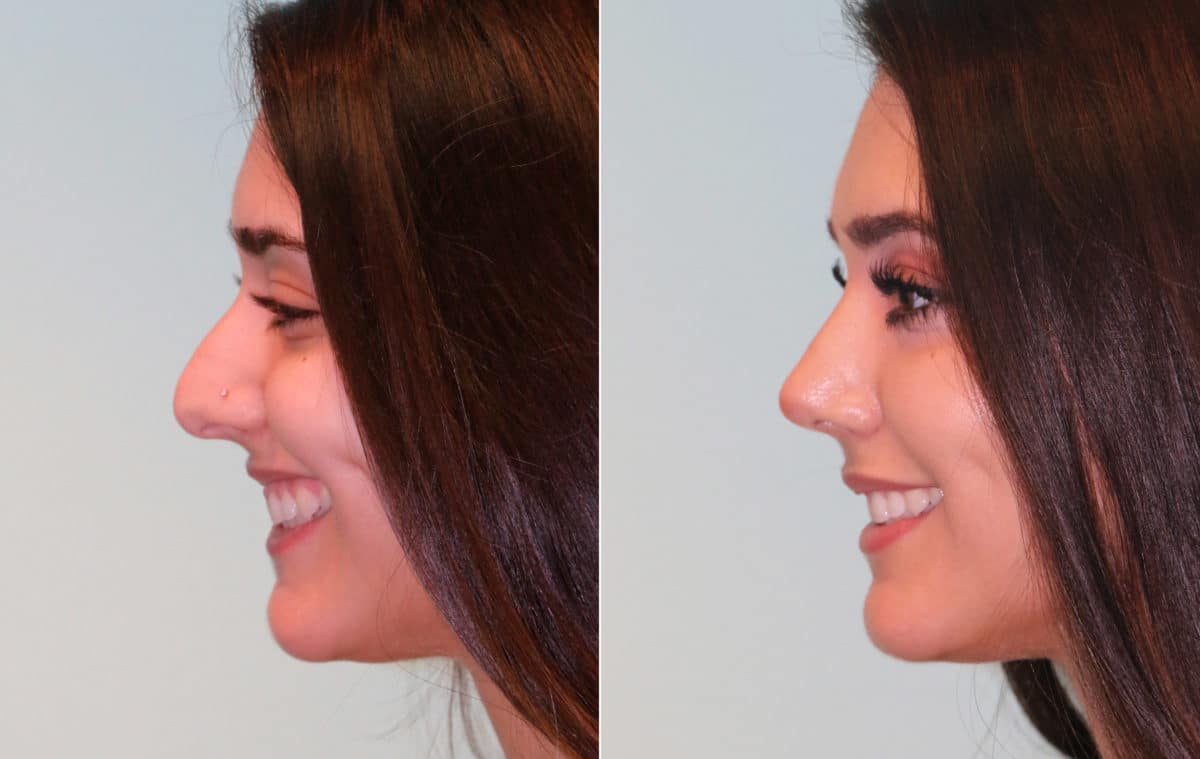 Before and after Rhinoplasty by Dr. Shervin Naderi, Patient 15325