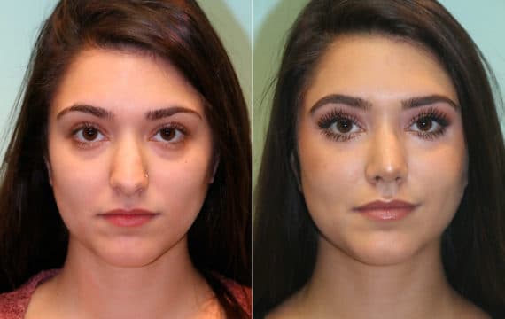 Before and after Rhinoplasty by Dr. Shervin Naderi, Patient 15325