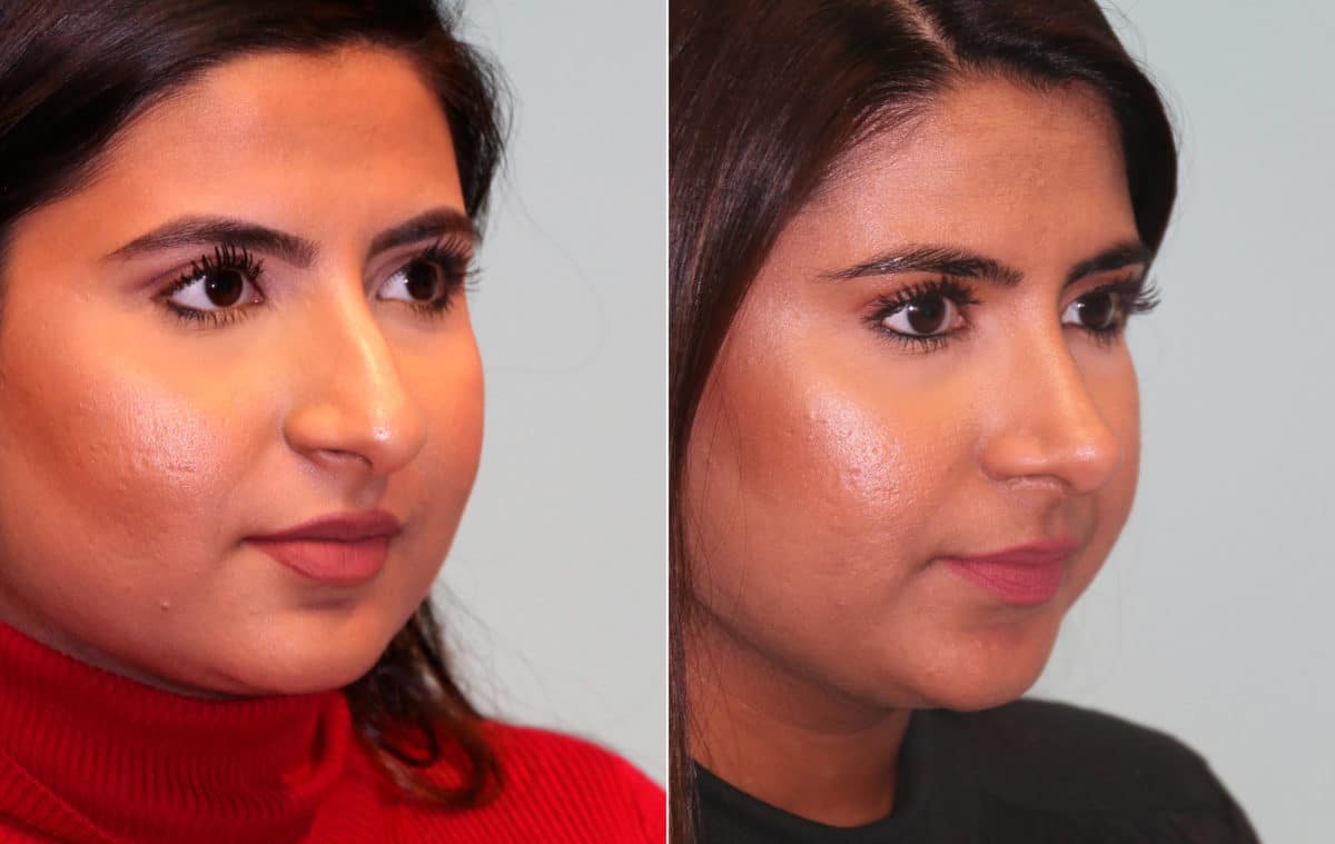 Before and after Rhinoplasty by Dr. Shervin Naderi, Patient 15354