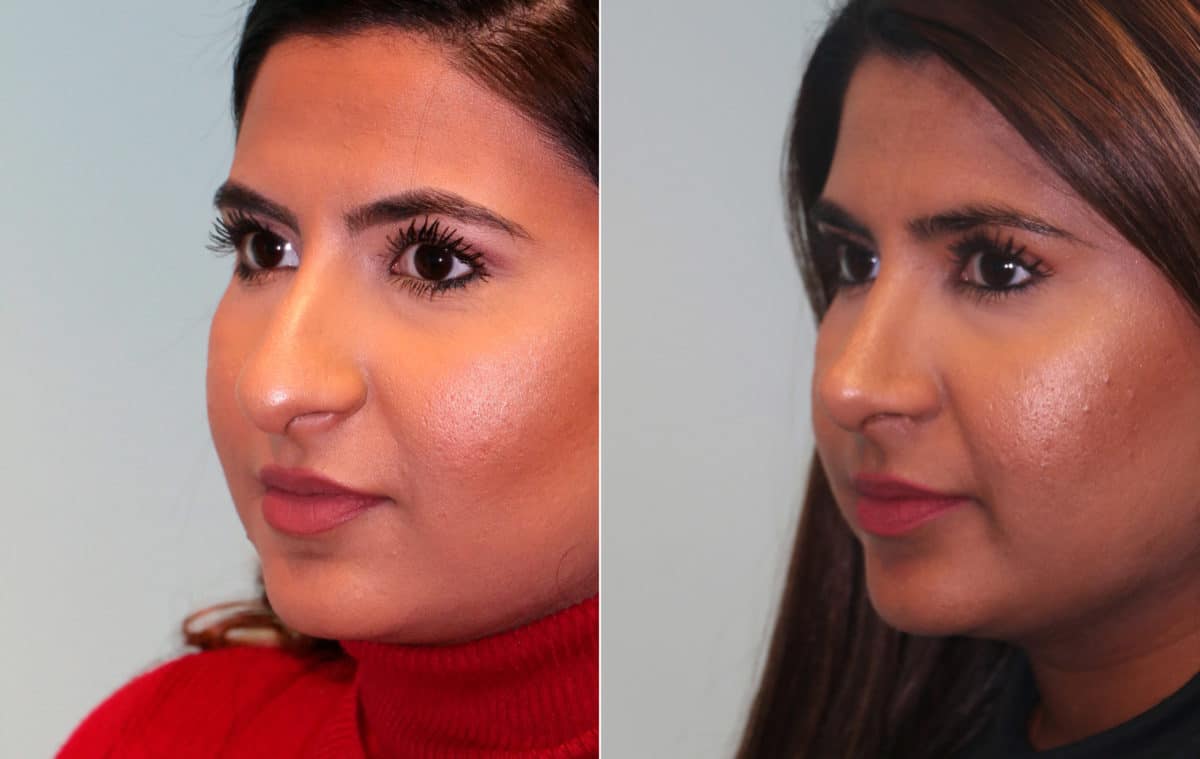 Before and after Rhinoplasty by Dr. Shervin Naderi, Patient 15354