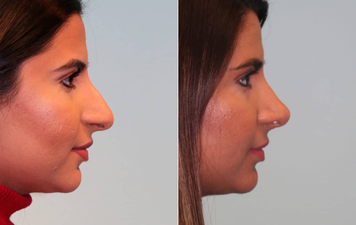 Before and after Rhinoplasty by Dr. Shervin Naderi, Patient 15354
