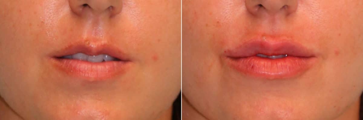 Before and after Lip Augmentation by Dr. Shervin Naderi, Patient 15747