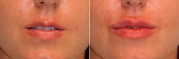 Before and after Lip Augmentation by Dr. Shervin Naderi, Patient 15747