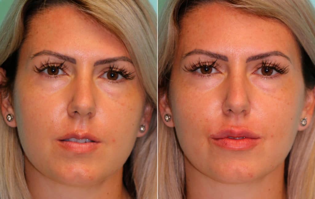 correction of lip asymmetries with lip augmentation through dermal fillers, done by top plastic surgeons at The Naderi Center in Virginia and Maryland