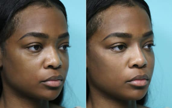 Before and after Non-Surgical Rhinoplasty by Dr. Shervin Naderi, Patient 15755