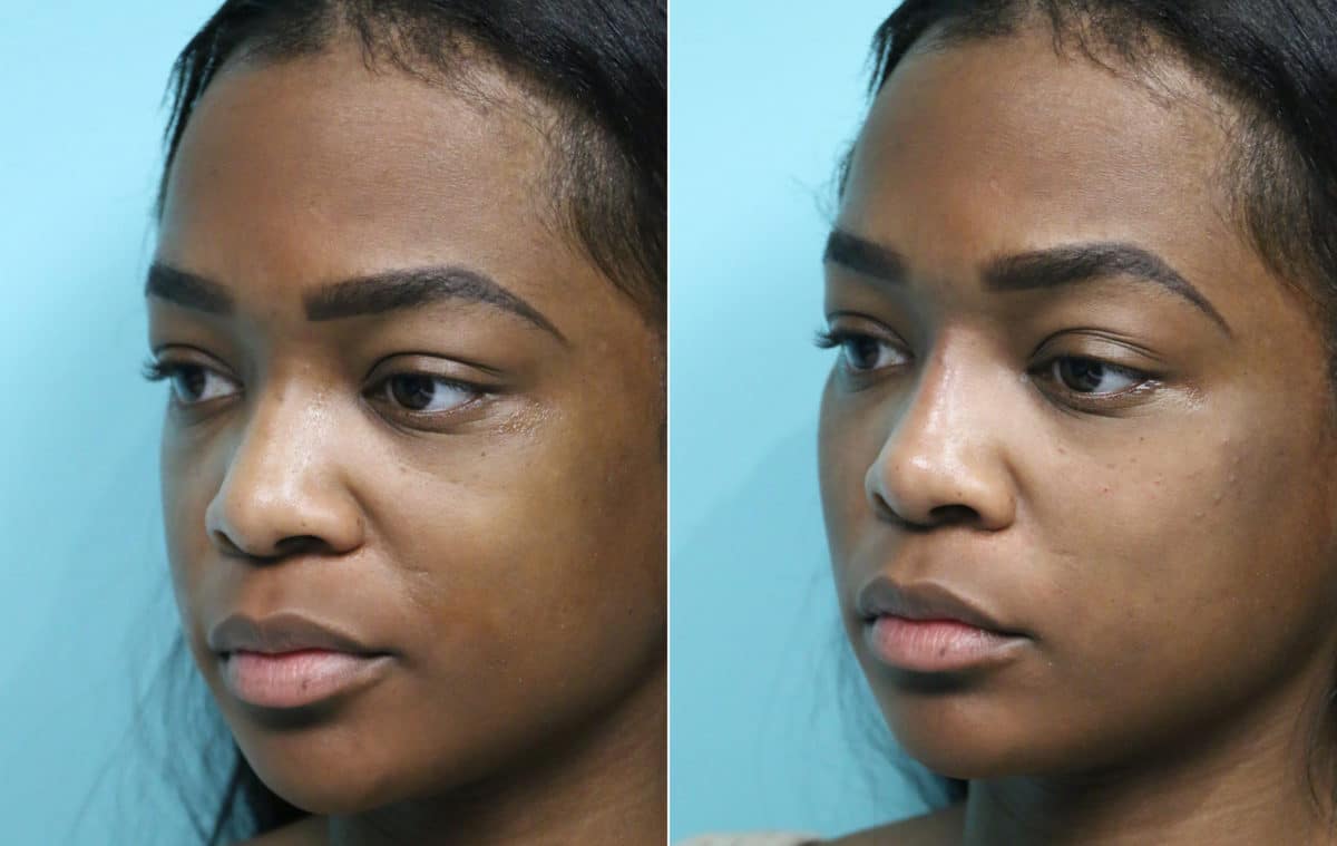 Before and after Non-Surgical Rhinoplasty by Dr. Shervin Naderi, Patient 15755