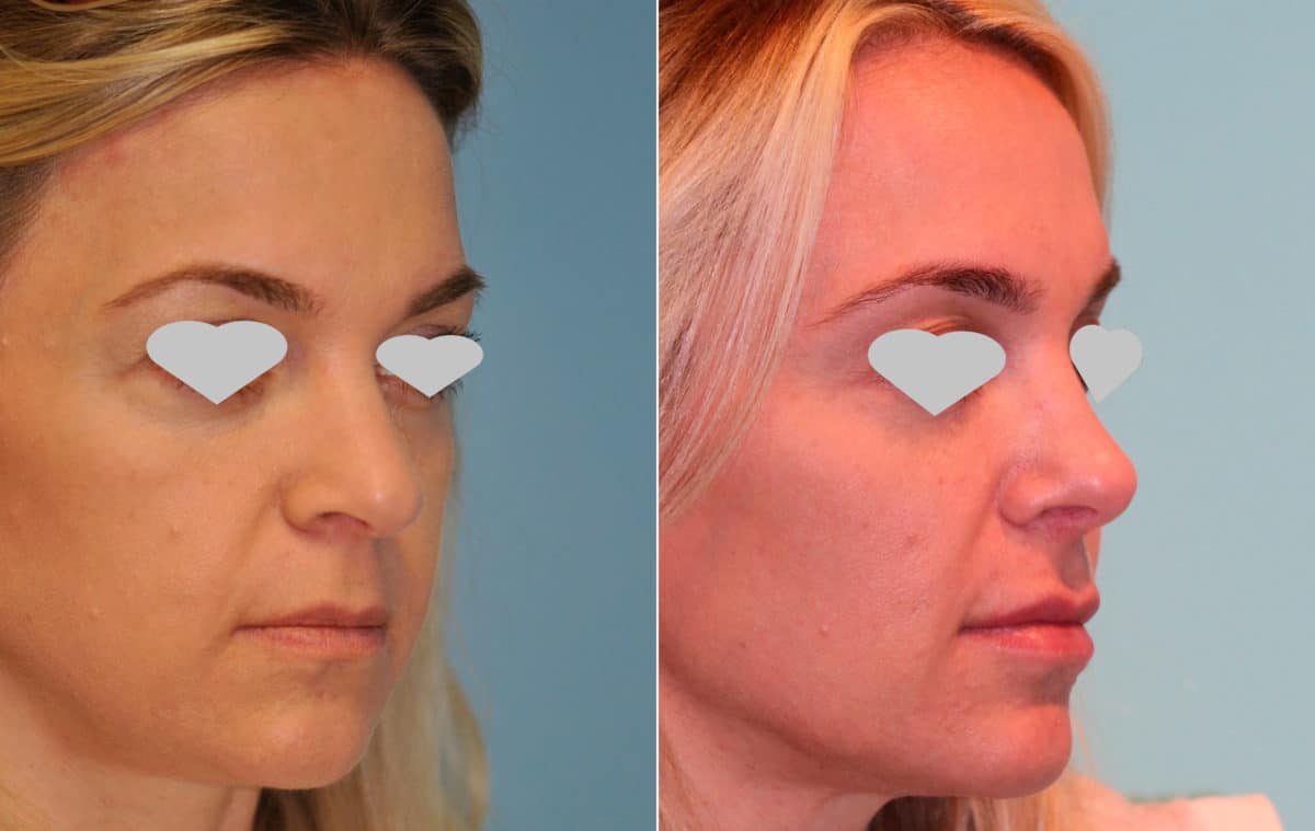 Before and after Revision Rhinoplasty by Dr. Shervin Naderi, Patient 15694