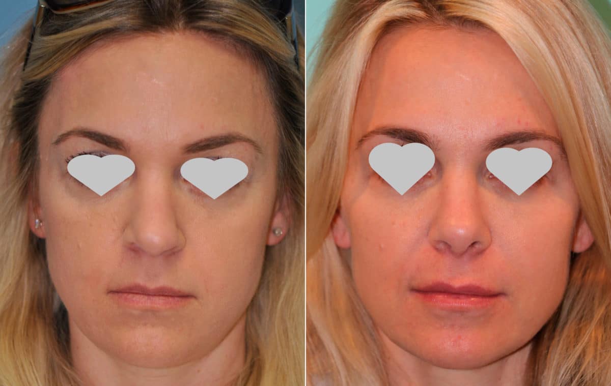 Before and after Revision Rhinoplasty by Dr. Shervin Naderi, Patient 15694