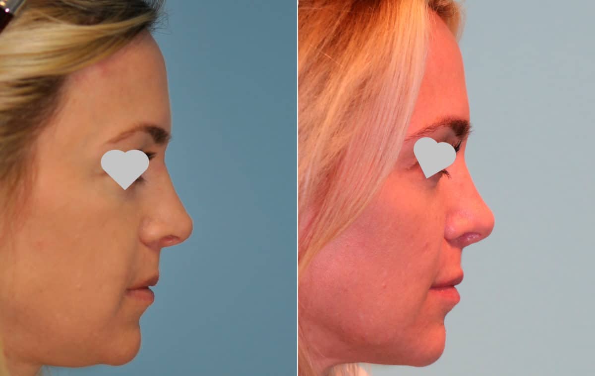 Before and after Revision Rhinoplasty by Dr. Shervin Naderi, Patient 15694