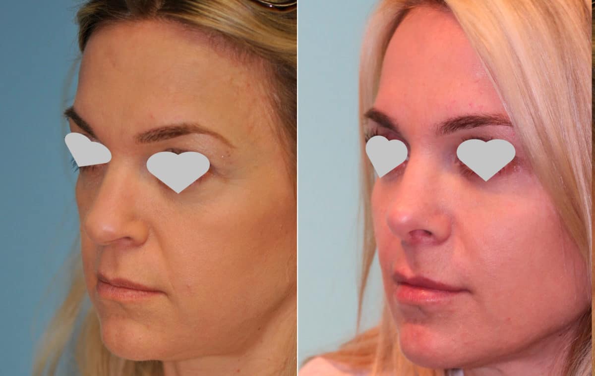 Before and after Revision Rhinoplasty by Dr. Shervin Naderi, Patient 15694