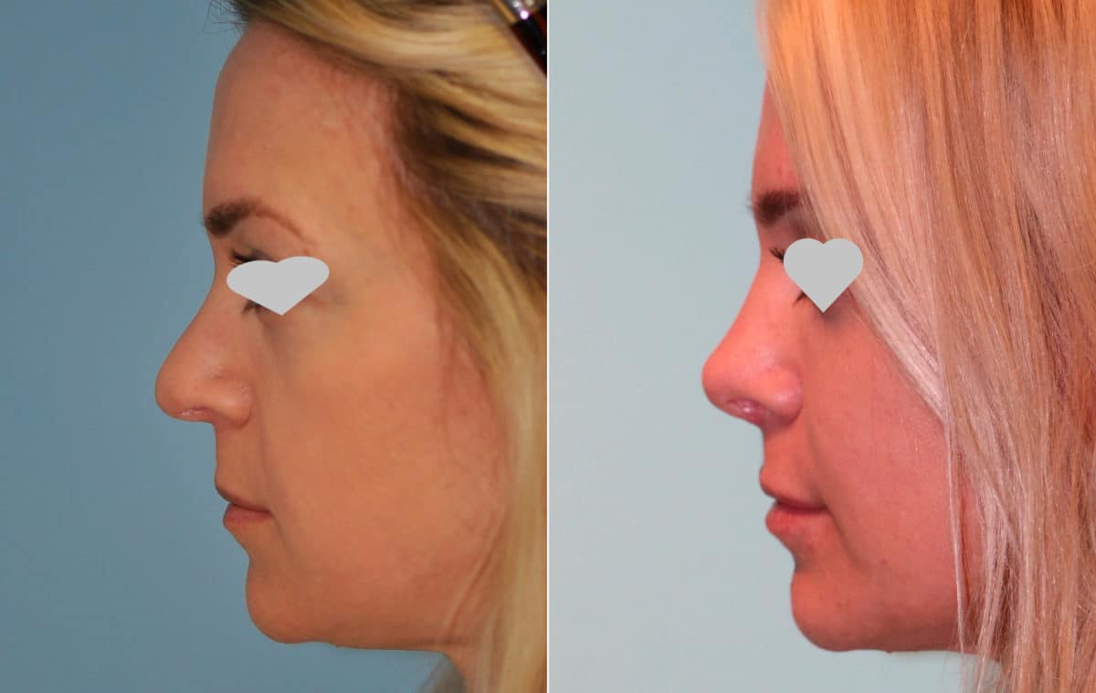 Before and after Revision Rhinoplasty by Dr. Shervin Naderi, Patient 15694