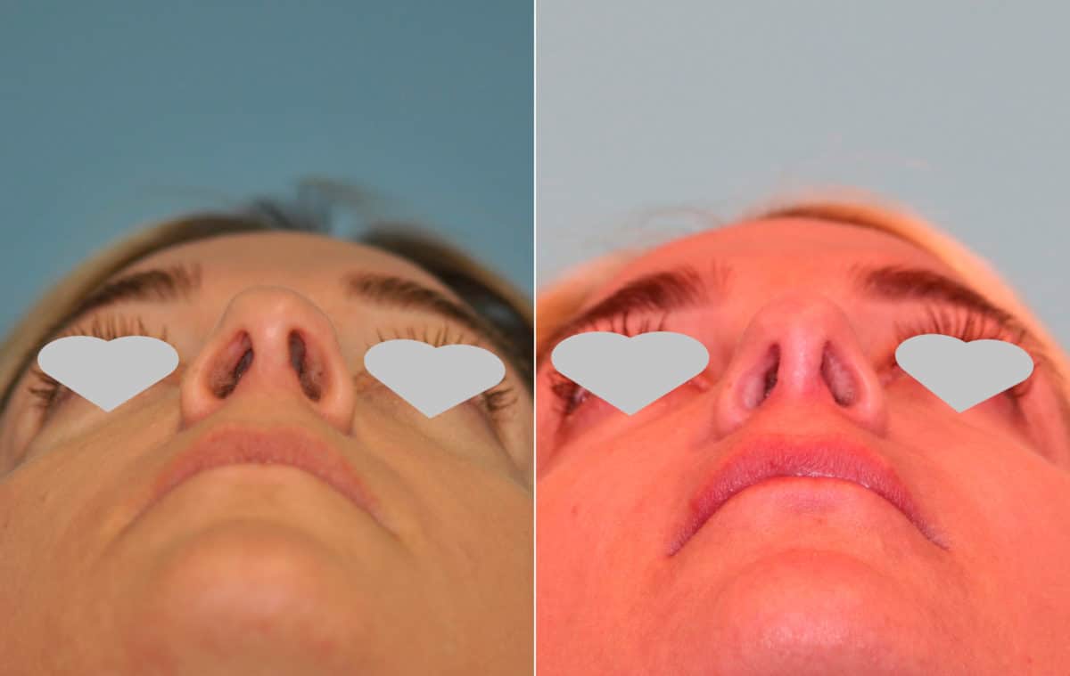 Before and after Revision Rhinoplasty by Dr. Shervin Naderi, Patient 15694