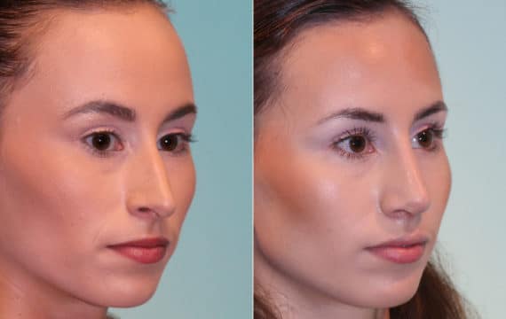 Before and after Rhinoplasty by Dr. Shervin Naderi, Patient 15657