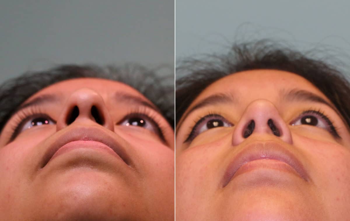 Before and after Rhinoplasty by Dr. Shervin Naderi, Patient 15674