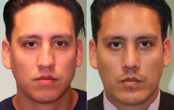 Before and after Rhinoplasty by Dr. Shervin Naderi, Patient 15714